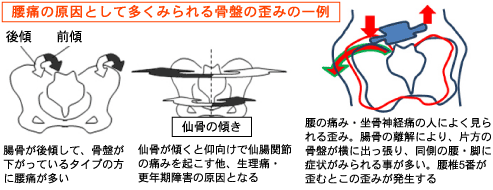 ���ɂ̌����Ƃ��đ����݂��鍜�Ղ̘c�݂̈��@���x���N�@�E�}�T�S�����@